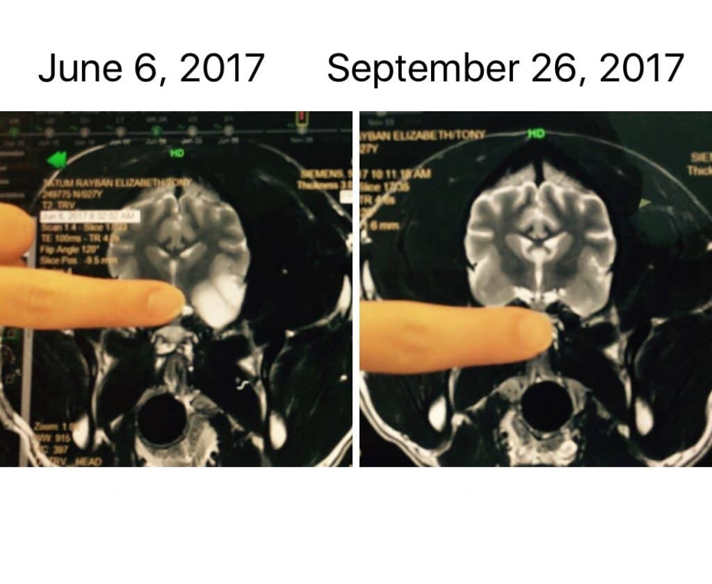 Two MRI scans dated June 6, 2017, and September 26, 2017, showing a side-by-side comparison with a finger pointing at a specific area in both images.